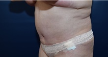 Tummy Tuck After Photo by Michael Dobryansky, MD, FACS; Garden City, NY - Case 40842