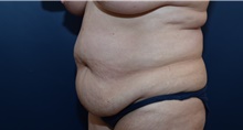 Tummy Tuck Before Photo by Michael Dobryansky, MD, FACS; Garden City, NY - Case 40842
