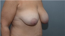 Breast Lift Before Photo by Michael Dobryansky, MD, FACS; Garden City, NY - Case 40843