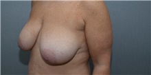 Breast Lift Before Photo by Michael Dobryansky, MD, FACS; Garden City, NY - Case 40843