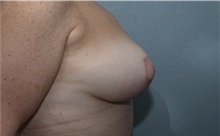 Breast Lift After Photo by Michael Dobryansky, MD, FACS; Garden City, NY - Case 40843