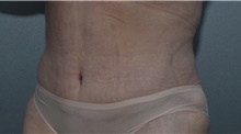 Tummy Tuck After Photo by Michael Dobryansky, MD, FACS; Garden City, NY - Case 40844