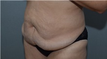Tummy Tuck Before Photo by Michael Dobryansky, MD, FACS; Garden City, NY - Case 40844