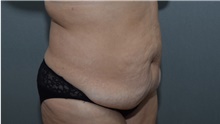 Tummy Tuck Before Photo by Michael Dobryansky, MD, FACS; Garden City, NY - Case 40844