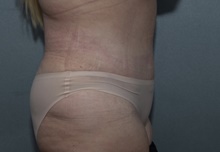 Tummy Tuck After Photo by Michael Dobryansky, MD, FACS; Garden City, NY - Case 40844