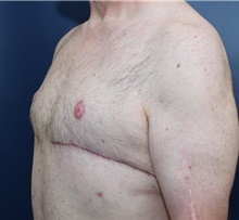 Male Breast Reduction After Photo by Michael Dobryansky, MD, FACS; Garden City, NY - Case 40845