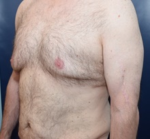 Male Breast Reduction Before Photo by Michael Dobryansky, MD, FACS; Garden City, NY - Case 40845