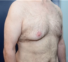 Male Breast Reduction Before Photo by Michael Dobryansky, MD, FACS; Garden City, NY - Case 40845