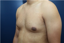 Male Breast Reduction Before Photo by Michael Dobryansky, MD, FACS; Garden City, NY - Case 40847