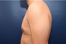 Male Breast Reduction After Photo by Michael Dobryansky, MD, FACS; Garden City, NY - Case 40847