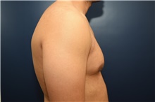 Male Breast Reduction Before Photo by Michael Dobryansky, MD, FACS; Garden City, NY - Case 40847
