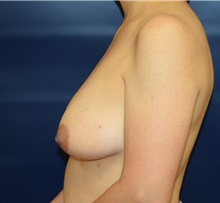 Breast Reconstruction Before Photo by Michael Dobryansky, MD, FACS; Garden City, NY - Case 41732