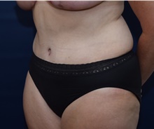 Tummy Tuck After Photo by Michael Dobryansky, MD, FACS; Garden City, NY - Case 41733