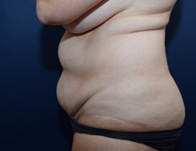 Tummy Tuck Before Photo by Michael Dobryansky, MD, FACS; Garden City, NY - Case 41733