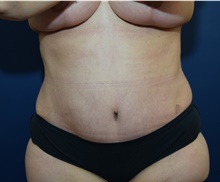 Tummy Tuck After Photo by Michael Dobryansky, MD, FACS; Garden City, NY - Case 41734