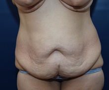 Tummy Tuck Before Photo by Michael Dobryansky, MD, FACS; Garden City, NY - Case 41734