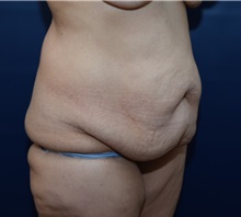 Tummy Tuck Before Photo by Michael Dobryansky, MD, FACS; Garden City, NY - Case 41734
