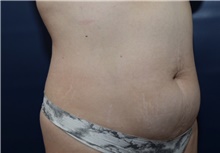 Tummy Tuck Before Photo by Michael Dobryansky, MD, FACS; Garden City, NY - Case 41735