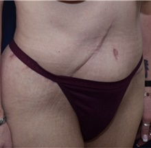 Tummy Tuck After Photo by Michael Dobryansky, MD, FACS; Garden City, NY - Case 41736