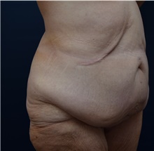 Tummy Tuck Before Photo by Michael Dobryansky, MD, FACS; Garden City, NY - Case 41736