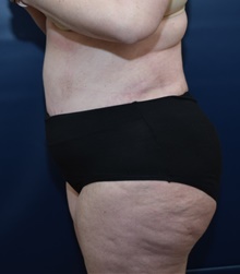 Tummy Tuck After Photo by Michael Dobryansky, MD, FACS; Garden City, NY - Case 41737