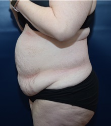 Tummy Tuck Before Photo by Michael Dobryansky, MD, FACS; Garden City, NY - Case 41737