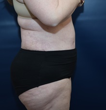Tummy Tuck After Photo by Michael Dobryansky, MD, FACS; Garden City, NY - Case 41737