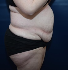 Tummy Tuck Before Photo by Michael Dobryansky, MD, FACS; Garden City, NY - Case 41737