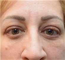 Eyelid Surgery After Photo by Michael Dobryansky, MD, FACS; Garden City, NY - Case 41738