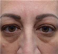 Eyelid Surgery Before Photo by Michael Dobryansky, MD, FACS; Garden City, NY - Case 41738