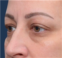Eyelid Surgery Before Photo by Michael Dobryansky, MD, FACS; Garden City, NY - Case 41738
