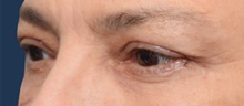 Eyelid Surgery After Photo by Michael Dobryansky, MD, FACS; Garden City, NY - Case 41739