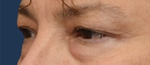 Eyelid Surgery Before Photo by Michael Dobryansky, MD, FACS; Garden City, NY - Case 41739