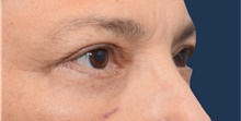 Eyelid Surgery After Photo by Michael Dobryansky, MD, FACS; Garden City, NY - Case 41739