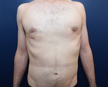 Male Breast Reduction After Photo by Michael Dobryansky, MD, FACS; Garden City, NY - Case 41740