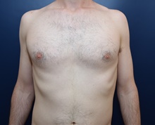 Male Breast Reduction Before Photo by Michael Dobryansky, MD, FACS; Garden City, NY - Case 41740