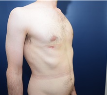 Male Breast Reduction After Photo by Michael Dobryansky, MD, FACS; Garden City, NY - Case 41740