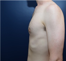 Male Breast Reduction Before Photo by Michael Dobryansky, MD, FACS; Garden City, NY - Case 41740