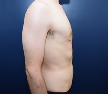 Male Breast Reduction After Photo by Michael Dobryansky, MD, FACS; Garden City, NY - Case 41740