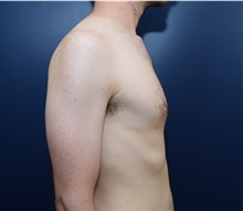 Male Breast Reduction Before Photo by Michael Dobryansky, MD, FACS; Garden City, NY - Case 41740