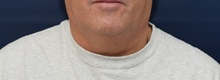 Neck Lift Before Photo by Michael Dobryansky, MD, FACS; Garden City, NY - Case 41741