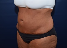 Tummy Tuck Before Photo by Michael Dobryansky, MD, FACS; Garden City, NY - Case 41742