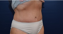 Tummy Tuck After Photo by Michael Dobryansky, MD, FACS; Garden City, NY - Case 41742