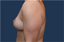 Breast Lift After Photo by Michael Dobryansky, MD, FACS; Garden City, NY - Case 41743