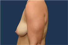 Breast Lift Before Photo by Michael Dobryansky, MD, FACS; Garden City, NY - Case 41743