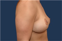 Breast Lift After Photo by Michael Dobryansky, MD, FACS; Garden City, NY - Case 41743