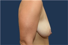 Breast Lift Before Photo by Michael Dobryansky, MD, FACS; Garden City, NY - Case 41743