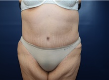 Tummy Tuck After Photo by Michael Dobryansky, MD, FACS; Garden City, NY - Case 41745