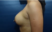 Breast Augmentation Before Photo by Michael Dobryansky, MD, FACS; Garden City, NY - Case 41746