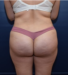 Liposuction After Photo by Michael Dobryansky, MD, FACS; Garden City, NY - Case 41750
